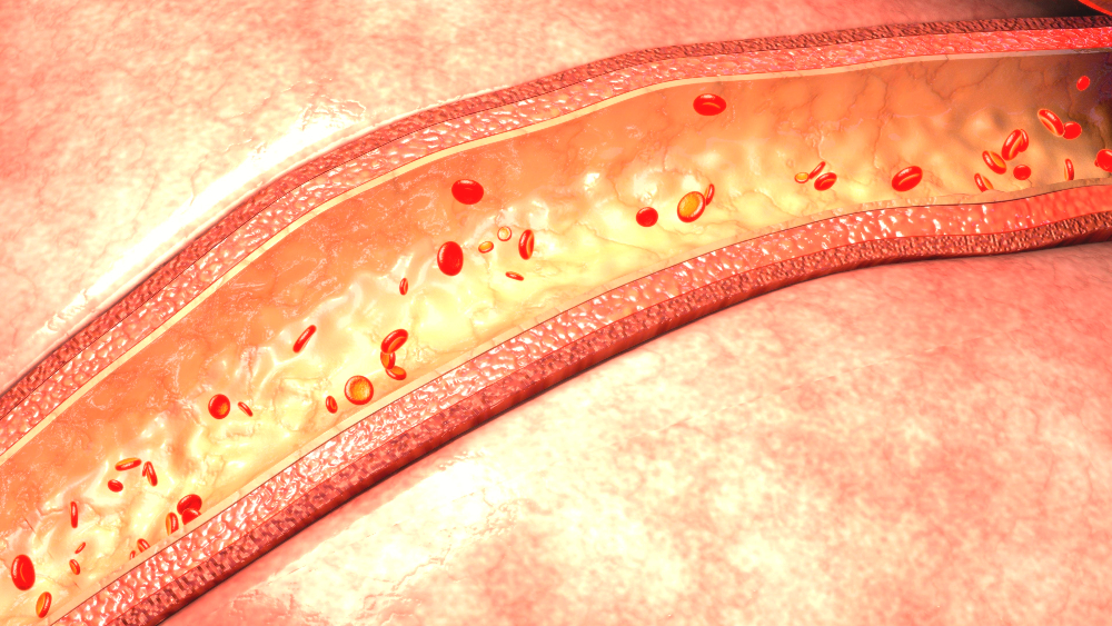 vasculitis.jpg